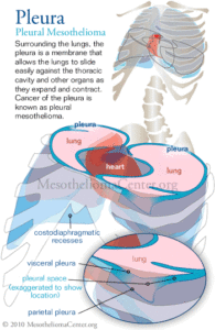 Pleura-pleural-mesothelioma